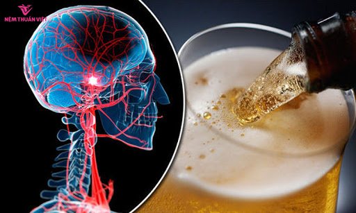 bia rượu nguyên nhân đột quỵ não